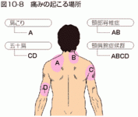 しびれ 痛み 腕