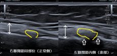坂戸市 主婦 左膝関節の痛み 捻挫 変形性膝関節症 ふじみ接骨院 坂戸市 主婦 左膝関節の痛み 捻挫 変形性膝関節症 ふじみ接骨院