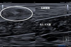 川越市 男性会社員 肉離れやっちゃったかも 左腓腹筋の肉離れ ふじみ接骨院 川越市 男性会社員 肉離れやっちゃったかも 左腓腹筋の肉離れ ふじみ接骨院