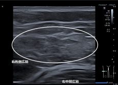 川越市 主婦 なかなか腫れが引かなくて 右太ももの痛み 打撲 ふじみ接骨院 川越市 主婦 なかなか腫れが引かなくて 右太ももの痛み 打撲 ふじみ接骨院