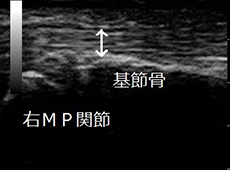 右長母指屈筋腱（正常）