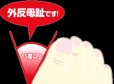 外反母趾痛の施術
