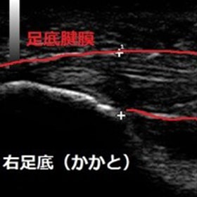 右足底（患部）