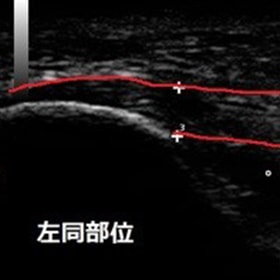 左同部位（正常側）